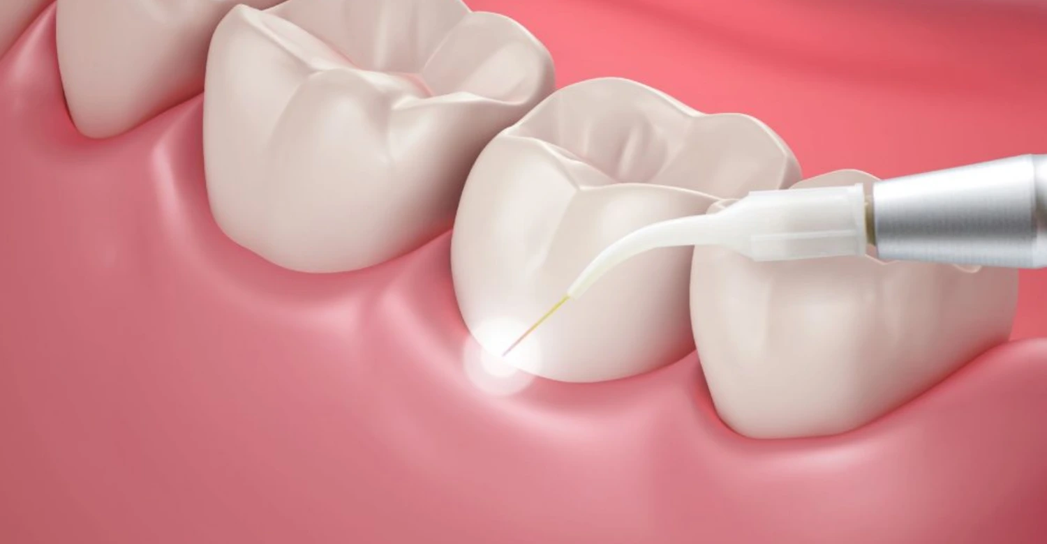 Laser Dentistry Recovery Time 2